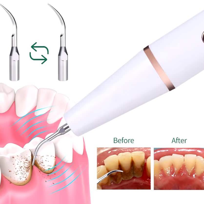 Outil de nettoyage de dents électrique avancé puissant dissolvant de tartre et de plaque dentaire