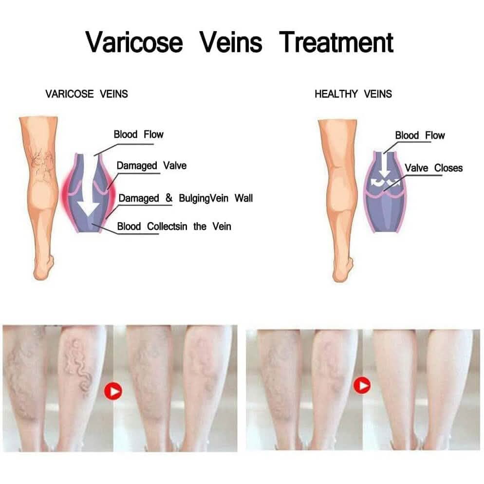 Varicose Deep Nourishing Soothing Vein Cream