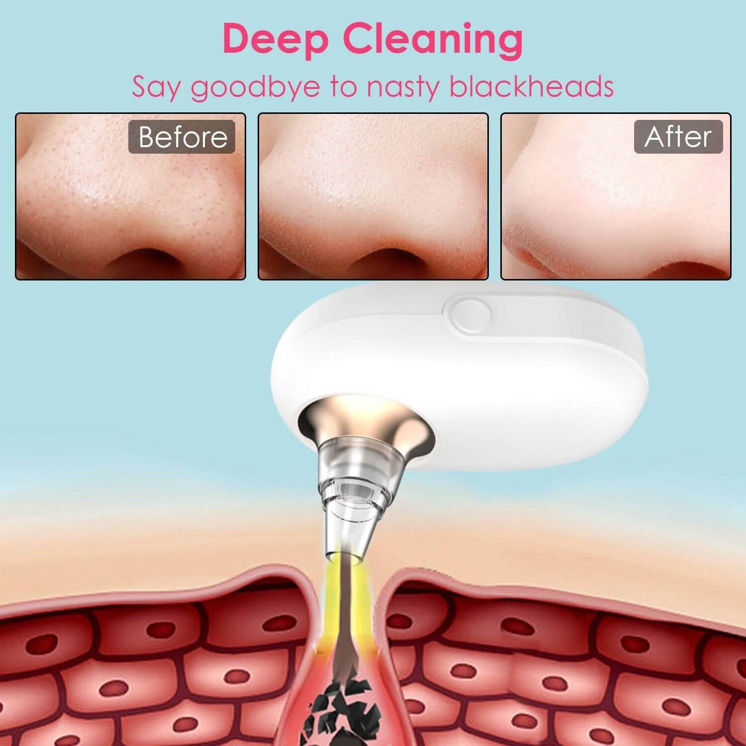 Extracteur électrique de points noirs et de comédons Outil de nettoyage des pores du visage
