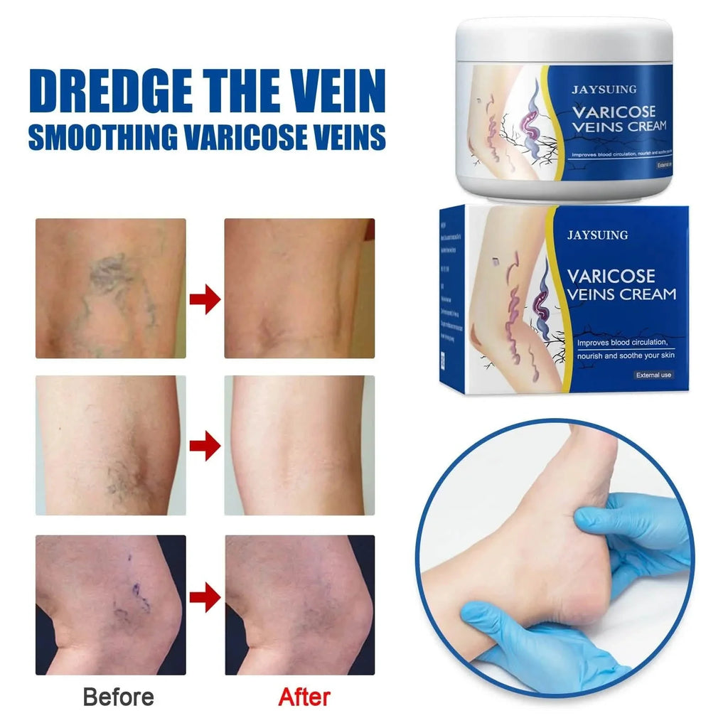 Soulagement de la douleur Jambes Veines Araignées Vascularite Favorise la circulation Métabolisme doux 30g Exfoliation