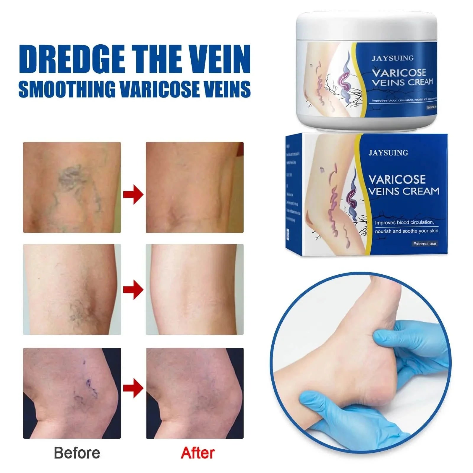 Soulagement de la douleur Jambes Veines Araignées Vascularite Favorise la circulation Métabolisme doux 30g Exfoliation