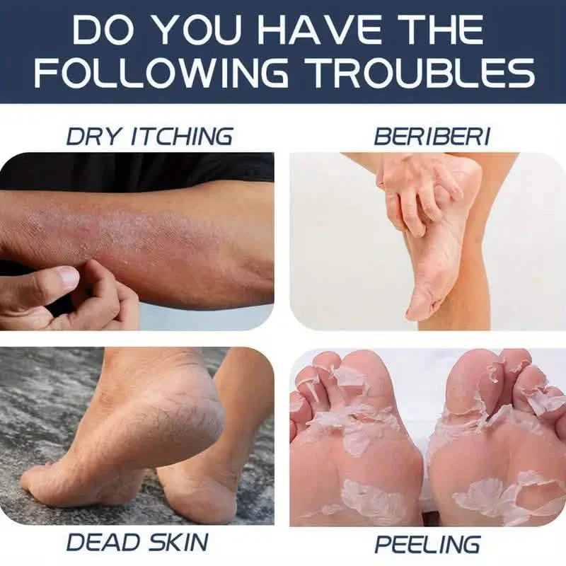 Crème de soin des pieds Trstay 50g / Crème de soin des pieds 40% urée et acide salicylique